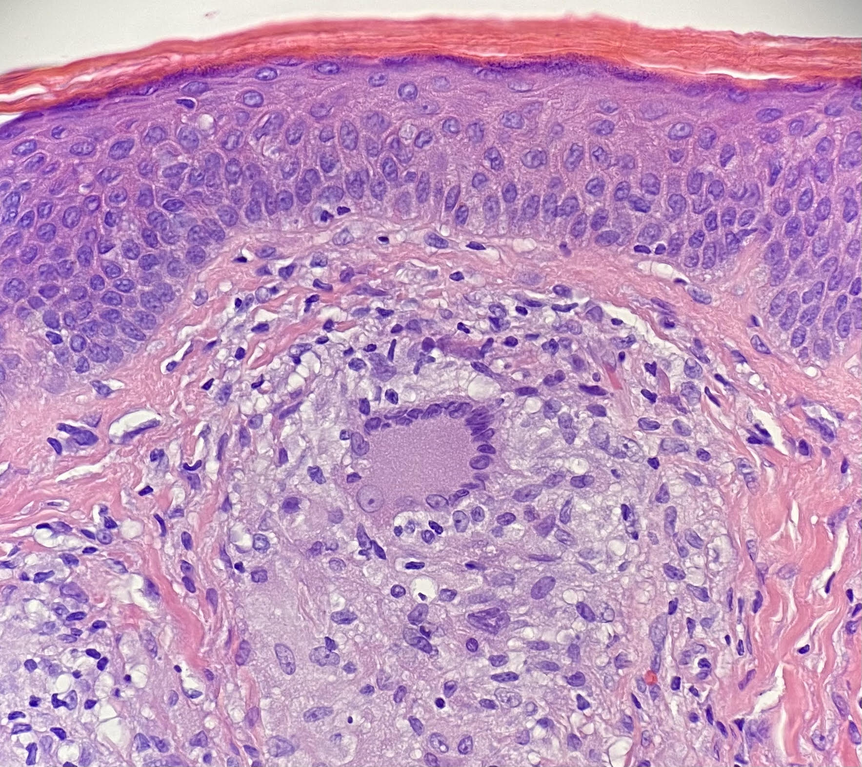 giant cell skin sample Dermatology Associates of Lancaster